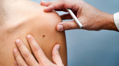 Día Mundial del Melanoma: se celebra un gran avance de científicos argentinos