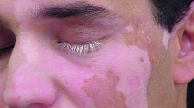 Vitíligo ¿Cómo es la enfermedad de las manchas blancas?