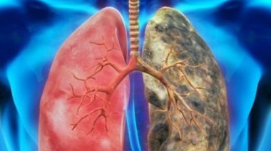¿Qué pasa con los pacientes con EPOC post COVID-19?