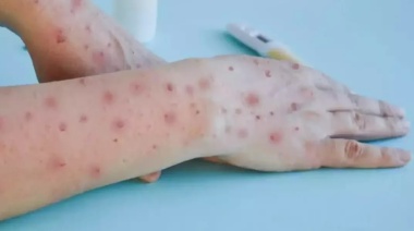 La Provincia refuerza controles para prevenir y detectar casos de viruela del mono