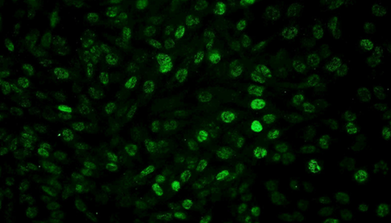 Científicos del CONICET logran frenar el glioblastoma en estudios preclínicos