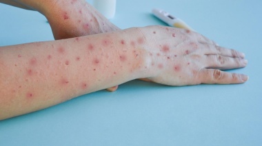 Viruela del mono: el Boletín Epidemiológico marca 5 casos en Argentina este año