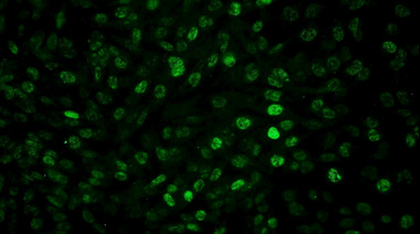 Científicos del CONICET logran frenar el glioblastoma en estudios preclínicos