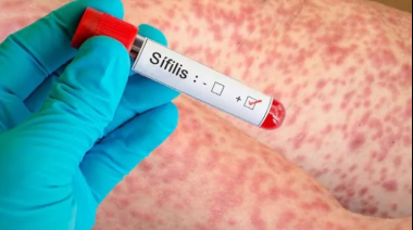 La sífilis marca un récord de contagios en Argentina y crece la preocupación sanitaria