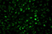 Científicos del CONICET logran frenar el glioblastoma en estudios preclínicos